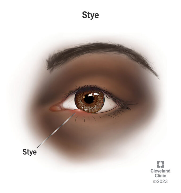 Stye Stye