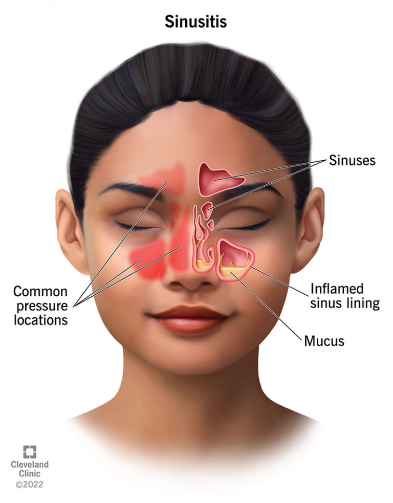 Sinus Infection (Sinusitis) Sinus Infection (Sinusitis)